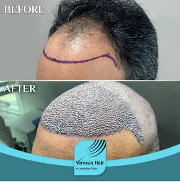 Slider image (4) United Hair Clinic